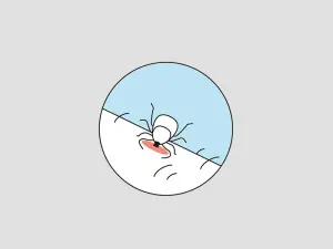 Illustration einer Zecke und deren Biss